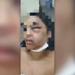Mulher denuncia ex após ter maxilar quebrado e ficar com rosto deformado